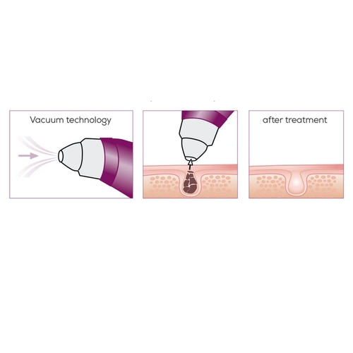 Масажер Beurer для обличчя вакуумний, акумулятор, USB, 3 режими, білий